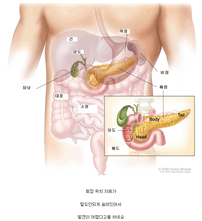 췌장암 발견이 어려운 이유