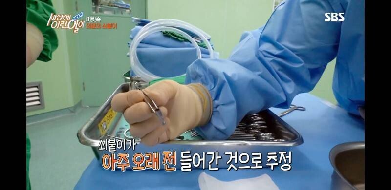 우산 촉이 머리 속에 들어간 사연