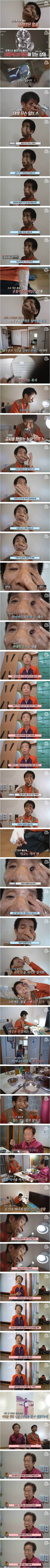 얼굴을 뒤덮은 섬유종