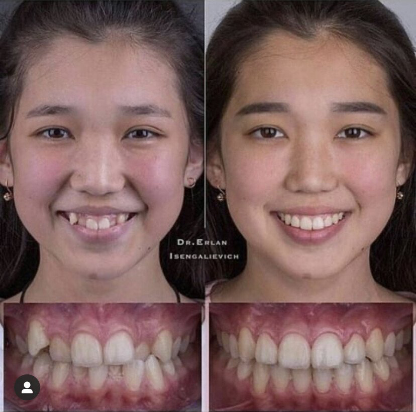 치아교정의 순기능