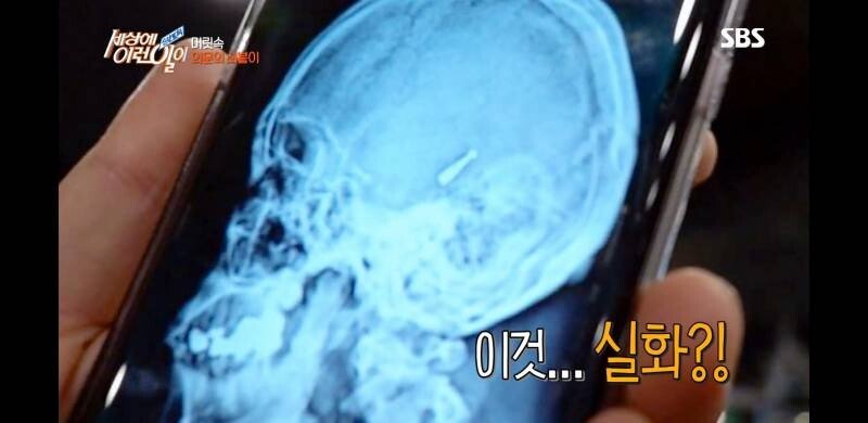 우산 촉이 머리 속에 들어간 사연