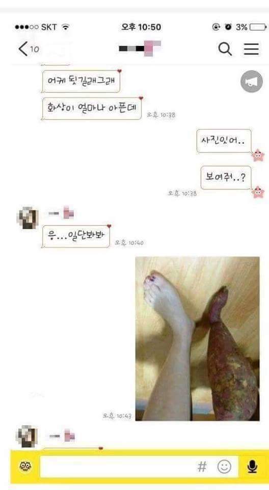 다리에 화상 입은 여자