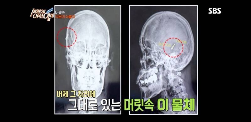 우산 촉이 머리 속에 들어간 사연