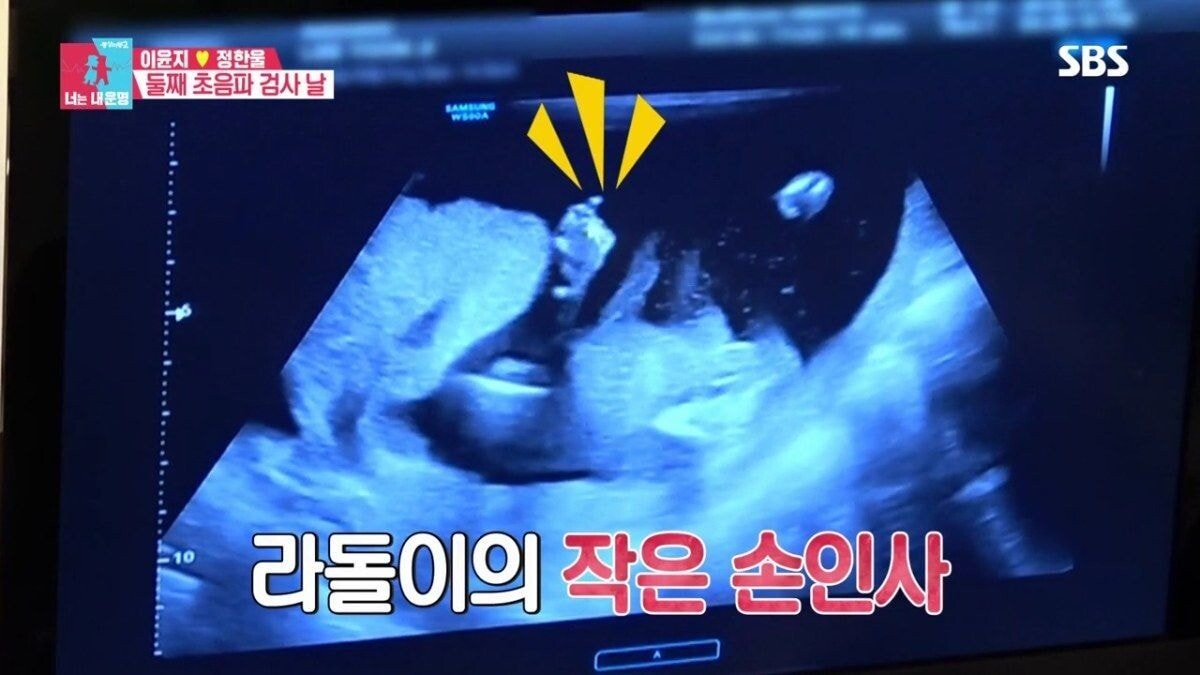 둘째를 임신한 이윤지가 말하는 유산 경험