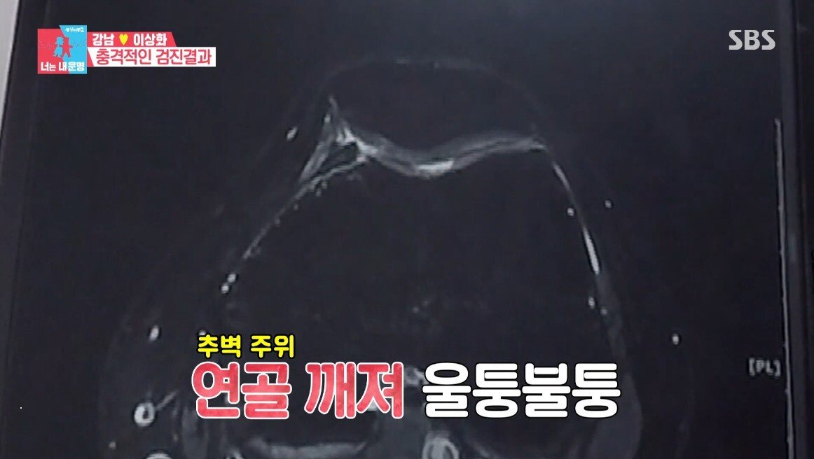 이상화의 현재 무릎 상태