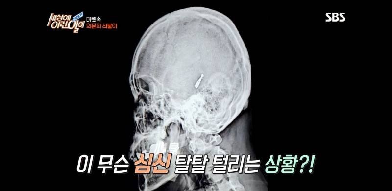 우산 촉이 머리 속에 들어간 사연