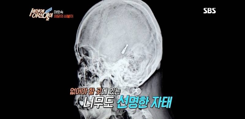 우산 촉이 머리 속에 들어간 사연