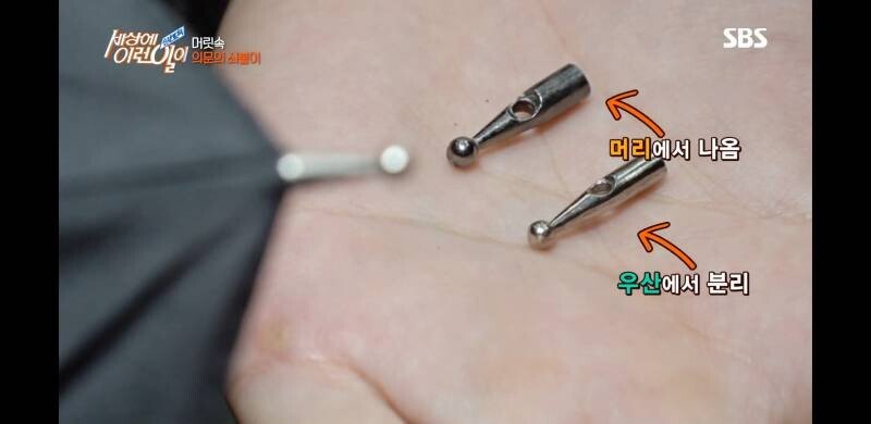 우산 촉이 머리 속에 들어간 사연