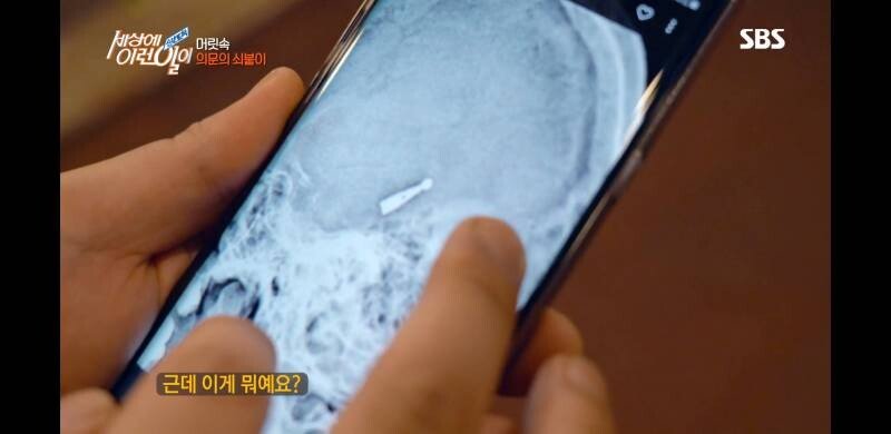 우산 촉이 머리 속에 들어간 사연