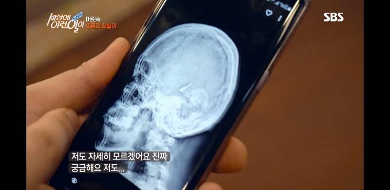 우산 촉이 머리 속에 들어간 사연