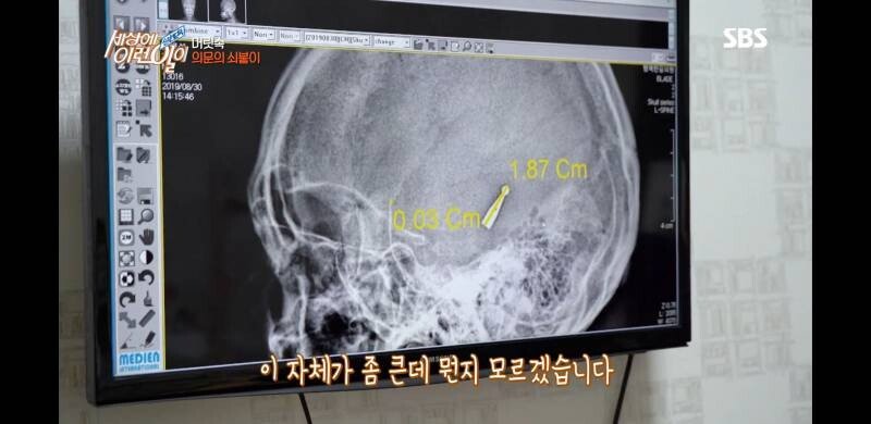 우산 촉이 머리 속에 들어간 사연