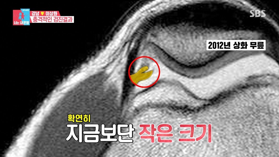 이상화의 현재 무릎 상태