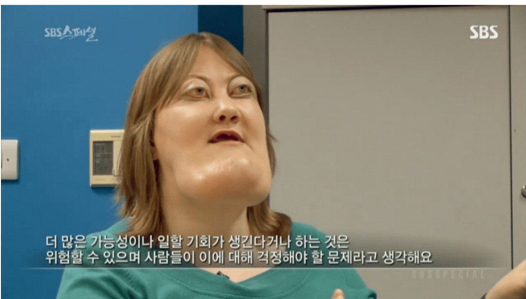 기형 턱을 가진 여성