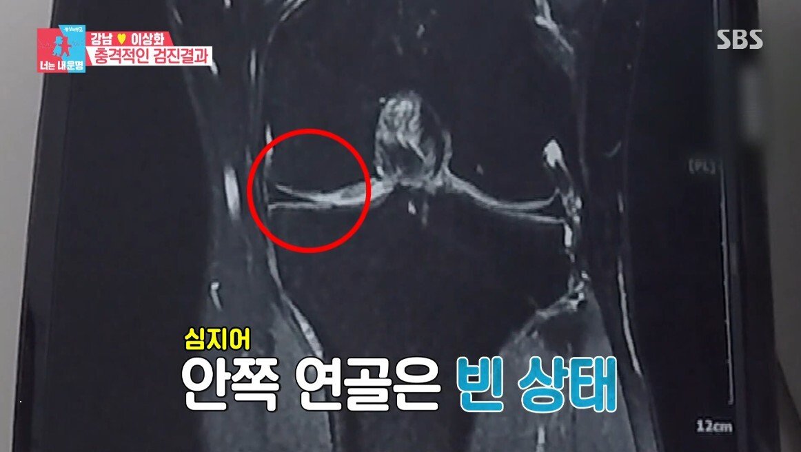 이상화의 현재 무릎 상태