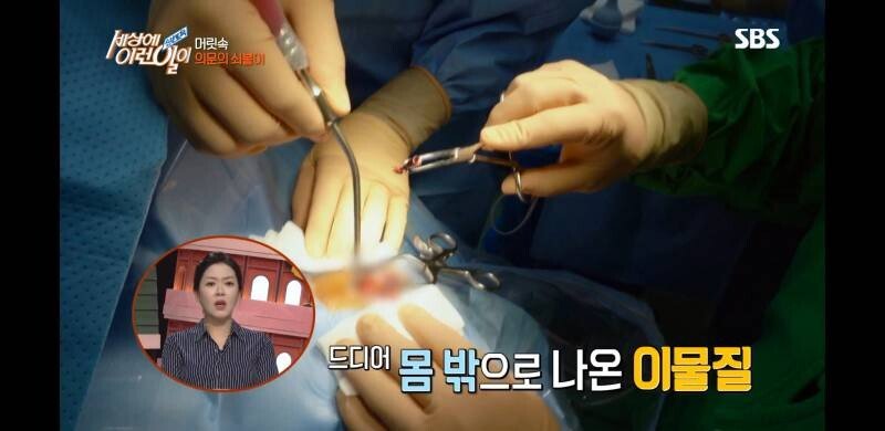 우산 촉이 머리 속에 들어간 사연