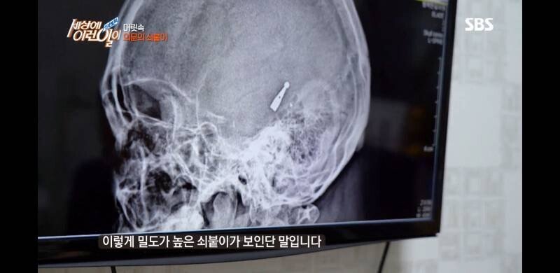 우산 촉이 머리 속에 들어간 사연