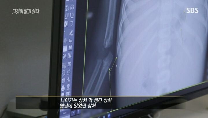 그것이 알고싶다 응급의학과 전문의 인터뷰