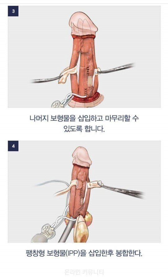 남자 성기 확대 수술 과정