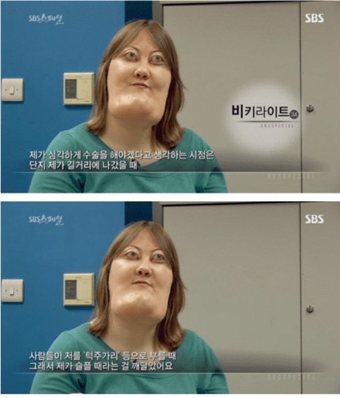 기형 턱을 가진 여성