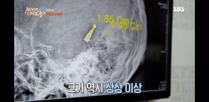 우산 촉이 머리 속에 들어간 사연
