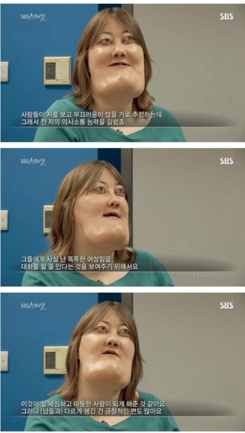 기형 턱을 가진 여성