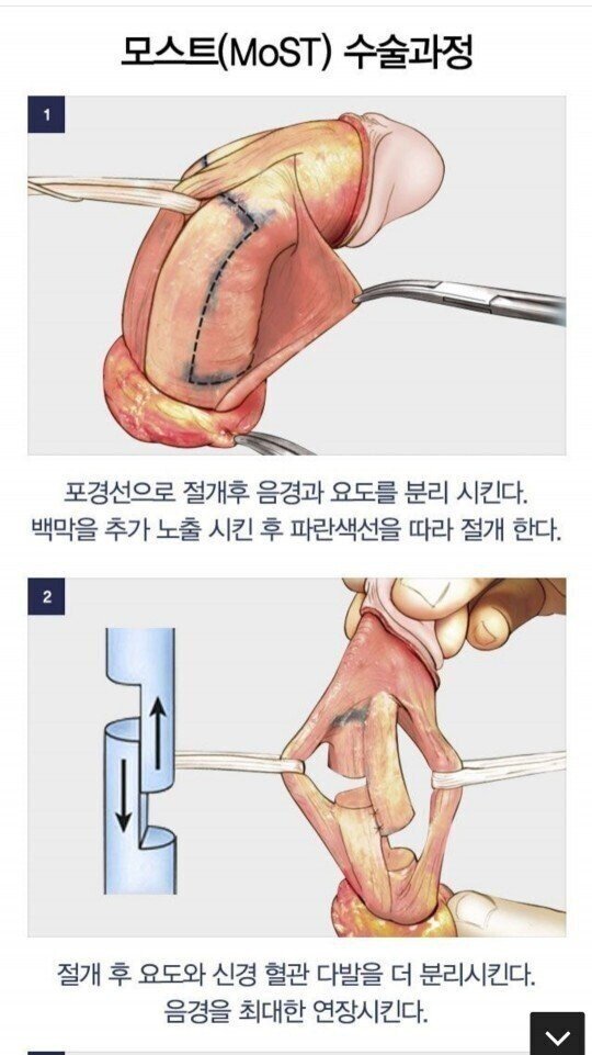 남자 성기 확대 수술 과정