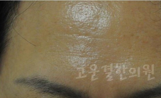 지루성피부염 고운결한의원에서 해결하자
