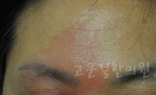 지루성피부염 고운결한의원에서 해결하자
