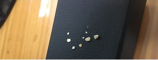 요로결석 인증샷