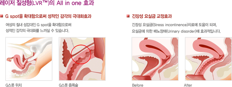 요즘 2~30대 여자가 많이 받는 시술